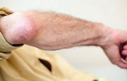 Psoriasis’s Effect on the Skin