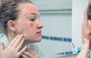 Psoriasis Triggers