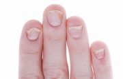 Nail Psoriasis