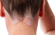 Remedies for Scalp Psoriasis