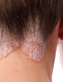 Caring for Scalp Psoriasis Caring for Scalp Psoriasis