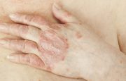 Symptoms of Psoriatic Arthritis