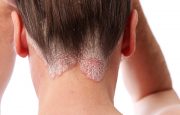 Scalp Psoriasis