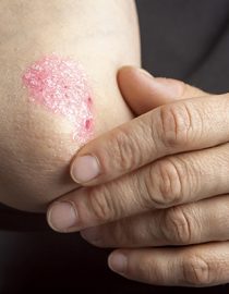 Difference Between Eczema and Psoriasis Difference Between Eczema and Psoriasis