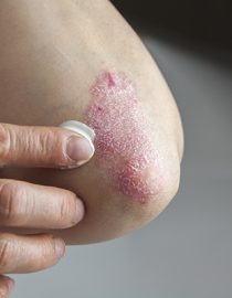 Types of Psoriasis Types of Psoriasis