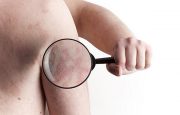 Symptoms of Psoriasis