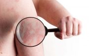 Psoriasis Symptoms