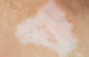Psoriasis White Patches