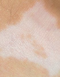 Psoriasis White Patches Psoriasis White Patches