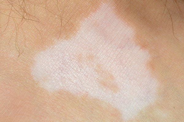 White Marks On Skin Disease