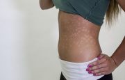 11 Things You Might Not Know About Psoriasis