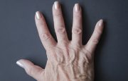 Psoriasis Swelling