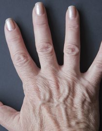 Psoriatic Arthritis: Caring for Your Hands and Feet Psoriatic Arthritis: Caring for Your Hands and Feet