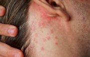 Psoriasis misdiagnosis