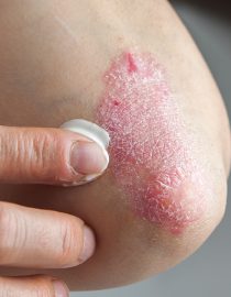 What Is Plaque Psoriasis? What Is Plaque Psoriasis?
