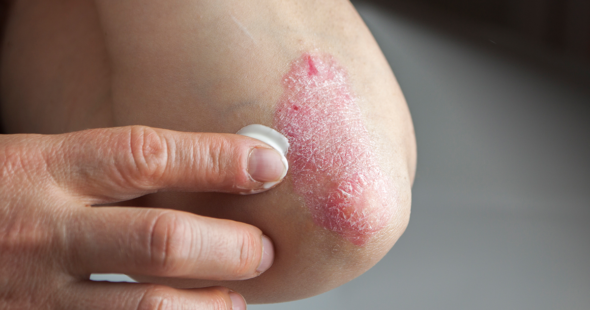 Plaque Psoriasis: What Is It, How Do You Get It and How Do You Treat It?