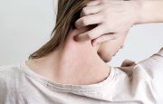 what is psoriasis